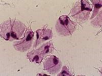 Ngứa và đau ở chỗ khó nói do bệnh trùng roi Trichomonas vaginalis