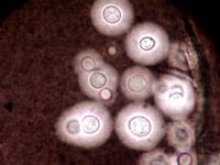 Phát hiện một bệnh nhân viêm não-màng não do bị nhiễm nấm tại Bệnh viện Trường Đại học Y Dược Huế