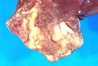 Thông tin cập nhật về tổn thương giải phẫu bệnh trong sán lá gan(Up-dating to Anapathology of FascioIiasis, Opisthorchiasis and Chlonorchiasis)