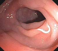 Hiểu biết về bệnh giun kim và mối quan tâm khi trẻ em than phiền với cha mẹ “Mẹ ơi ! Con bị ngứa !”