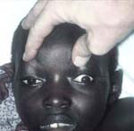 Phân loại đáp ứng điều trị bệnh sốt rét