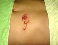 Phần II: Từ kháng trị thuốc giun sán trên gia súc đến cảnh báo tình hình kháng thuốc trên người không xa-một vấn đề chưa được quan tâm ở Việt Nam