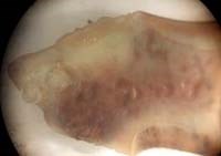 Bệnh sán lá gan lớn (Fasciola) và thuốc Egaten