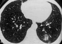 Hội chứng Loffler trên các bệnh do ký sinh trùng ở người (Lofffler’s syndrome in human parasitic diseases)