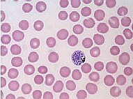 Thông báo hai trường hợp sốt rét ác tính thể não do Plasmodium vivax tại Ấn Độ