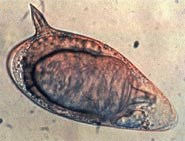 Ca bệnh Schistosoma mansoni thứ 3 được phát hiện tại Việt Nam