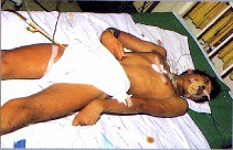 Những vấn đề nổi bật trong nghiên cứu sốt rét do P.vivax hiện nay (Outstanding problems in P. vivax malaria research nowadays)