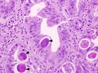 Một số thông tin bệnh giun lươn (Strongyloides stercoralis) và cảnh báo về tác hại của bệnh