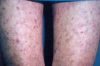 Sốt phát ban bụi rậm là bệnh gì ?