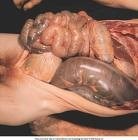 Bệnh giun kim dễ phát hiện nhưng không dễ điều trị