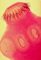 Bệnh sán dây (Taeniasis) ở người