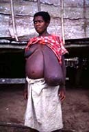 Việt Nam đang tiến tới đến mục tiêu loại trừ  bệnh Giun chỉ bạch huyết vào năm 2010