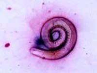 Hội chứng suy hô hấp do giun lươn Strongyloides stercoralis