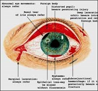 Bệnh giun Thelazia callipaeda ký sinh và gây bệnh ở người lần đầu tiên phát hiện ở Việt Nam