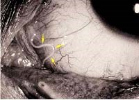 Cập nhật một số ca bệnh lâm sàng đặc biệt do nhiễm giun trên thế giới