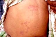 Hội chứng ấu trùng di chuyển hoặc ban trườn do ký sinh trùng gây ra tại vị trí hiếm gặp