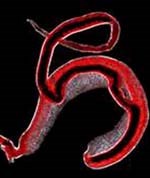 Phát hiện bệnh sán máng (Schistosomiasis) hiếm gặp tại Việt Nam