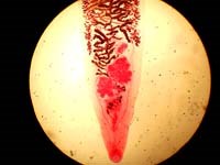 Báo cáo hai ca bệnh nhiễm sán lá Dicrocoelium dendriticum