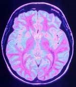 Phát hiện loài sâu sống trong não người