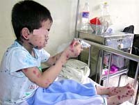 Cảnh báo bệnh thủy đậu phát triển