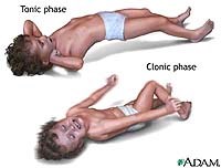 Sốt rét thể giá lạnh và sốt không rõ nguyên nhân (Algid Malaria and Fever of Unknown Origin)