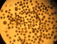 Bệnh sán lá phổi (Paragonimiasis)