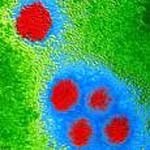 Chẩn đoán lâm sàng, hình ảnh siêu âm và nội soi tiêu hóa trên bệnh nhân sốt Dengue/sốt xuất huyết Dengue