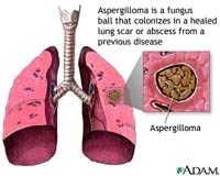 Vi nấm Aspergillus fumigatus và căn bệnh u nấm phổi ở người