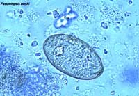 Bệnh sán lá ruột (Fasciolopsiasis)