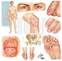 Tác nhân vi khuẩn chlammydia trachomatis và bệnh lây truyền qua đường tình dục