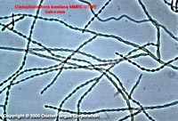 Báo cáo một trường hợp áp xe não do nhiễm hai loại nấm Candida albicans và Cladosporium batiana