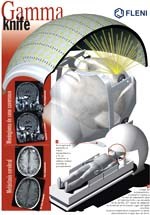 Bạn biết gì về phẫu thuật bằng Dao Gamma (Gamma knife) ?