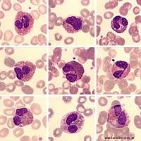 Thông số bạch cầu ái toan tăng cao liên quan đến một số bệnh lý ?