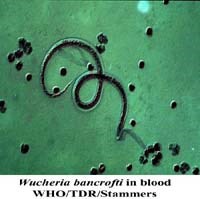 Mối nguy hiểm của bệnh giun chỉ bạch huyết