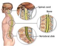 Không nên xem thường các triệu chứng đau lưng và thay đổi dáng đi ở trẻ em lứa tuổi học đường