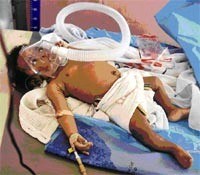 Gánh nặng về sốt rét ác tính thể não tại miền Trung Ấn Độ (2004-2007) và sốt rét nặng do Plasmodium vivax ở Bikaner-Tây Bắc Ấn Độ