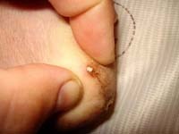 Công cụ chẩn đoán sốt rét mới loại microchip giúp phát hiện bệnh nhanh hơn và một số kỹ thuật tách lấy ký sinh trùng ra khỏi vết thương