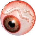 Bệnh mù lòa đường sông là bệnh như thế nào?