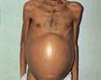 Sán lá gan gây bệnh gan mật