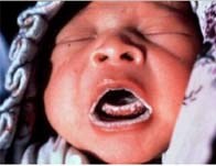 Vi nấm và bệnh vi nấm thường gặp