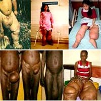 Phân biệt biến chứng phù chân voi do giun chỉ với các bệnh lý do rối loạn vi mạch & ở cơ, xương, khớp