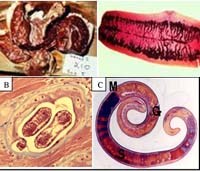 Một số bệnh ký sinh trùng ở đường tiêu hóa thường gặp