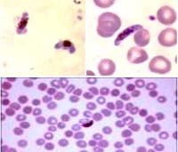 Ký sinh trùng sốt rét kháng thuốc và sốt rét điều trị không đáp ứng