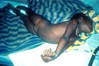 Nguy kịch vì bệnh sốt rét đái huyết cầu tố