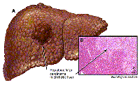Cập nhật các phương pháp điều trị ung thư biểu mô tế bào gan (HCC_Hepatocellular Carcinoma)