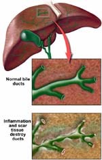Tổn thương bệnh lý hệ đường mật do các lòai sán lá