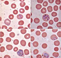 Phát hiện ca bệnh sốt rét Plasmodium ovale nhập khẩu (imported malaria case) tại Hàn Quốc bằng phương pháp sinh học phân tử