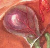 Nhân một ca bệnh sán lá gan lớn (Fasciola gigantica) gây biến chứng ứ mật và chảy máu đường mật