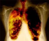 Triển vọng một loại thuốc mới cho bệnh nhân ung thư phổi