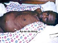 Áp xe gan do lỵ amíp